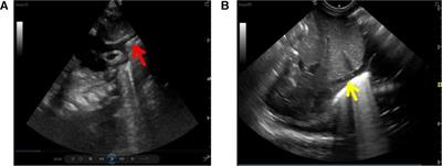 Comparison of bedside ultrasonography and bedside chest radiography in neonatal peripherally inserted central catheters: A before and after self-control study